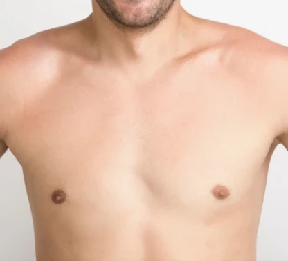 Gynecomastia (to Reduce Male Breast Size)