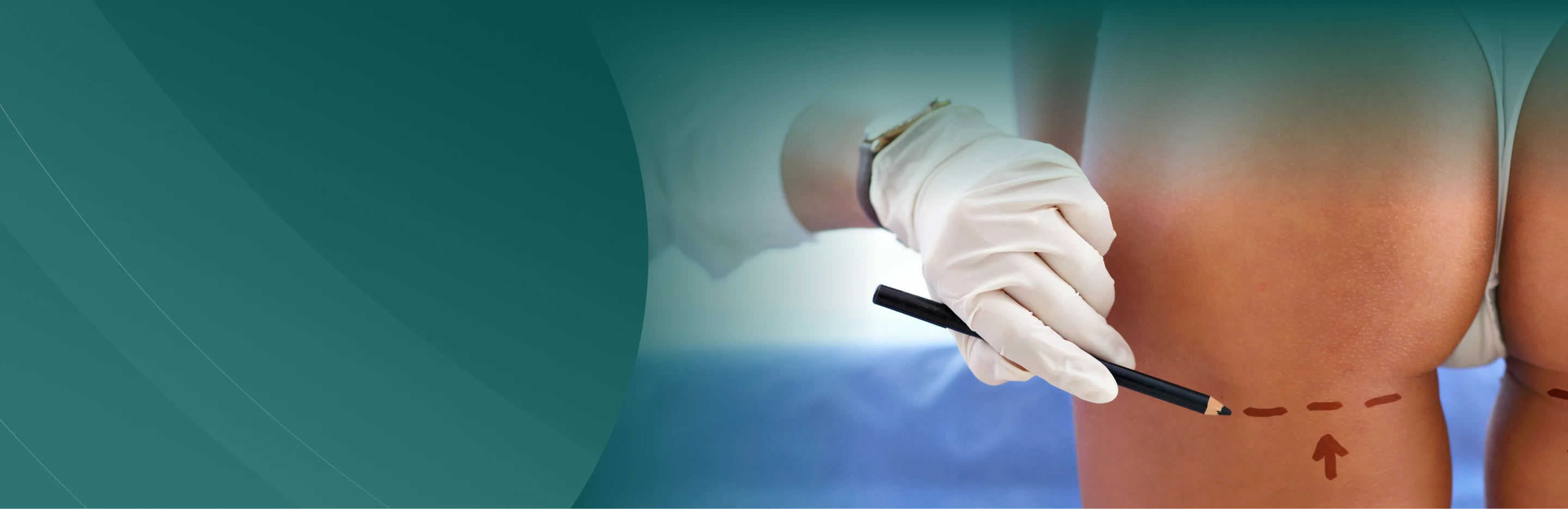 Gluteoplastia&nbsp;(Pr&oacute;tesis de Gl&uacute;teo)