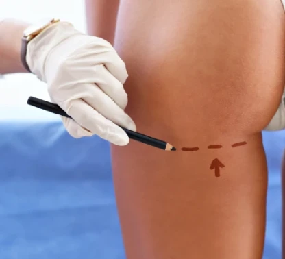 Gluteoplastia (Prótesis de Glúteo)